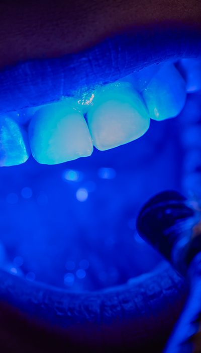 branqueamento dentário Branqueamento dentário